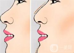 駝峰鼻矯正優(yōu)點(diǎn)和缺點(diǎn)是什么