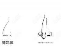 矯正鷹鉤鼻的方法及優(yōu)點(diǎn)
