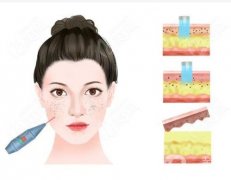皮秒有什么作用？多久可以洗臉