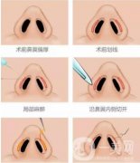 縮小鼻尖的方法有哪些？有后遺癥嗎