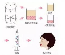 自體脂肪填充淚溝有哪些注意事項(xiàng)