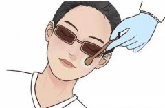 光子嫩膚酒渣鼻有效嗎