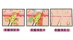 果酸換膚有什么危害，如何避免
