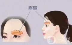 切眉手術(shù)安全嗎，適合什么年齡