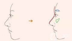 切眉手術(shù)有什么好處？多久能拆線