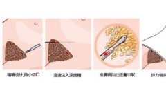 吸脂手術(shù)的效果是永久性的嗎