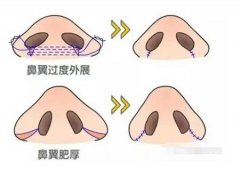 鼻翼縮小導(dǎo)致增生的原因是什么？