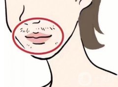 激光脫毛后毛發(fā)還會再長出來嗎？