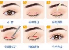 雙眼皮手術(shù)后眼睛真的會變大嗎？