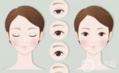 切眉手術(shù)后需要多長時間才能恢復(fù)自然？