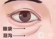 去眼袋手術(shù)有哪些風(fēng)險(xiǎn)和后遺癥