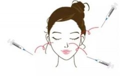 注射玻尿酸什么情況下會后悔？
