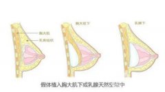 隆胸后有哪些事項需要注意