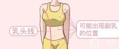 副乳切除效果是不是永久性的，會(huì)反彈嗎