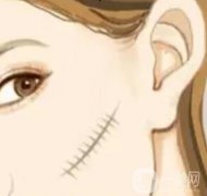 如何預防燒傷后留下疤痕