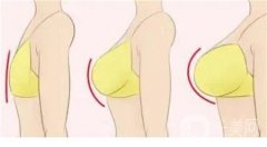 乳頭再造的方法有哪些？