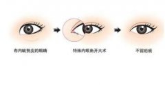 開內(nèi)眼角手術(shù)前后的注意事項有哪些？