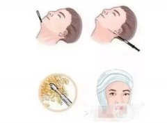 面部吸脂的優(yōu)點，以及適合什么情況