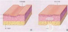 自體脂肪填充眉弓有什么副作用