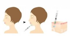 愛貝芙和玻尿酸有什么區(qū)別