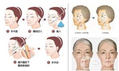 PST面部提升手術(shù)是如何進(jìn)行的