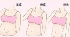 腹部吸脂手術(shù)的恢復(fù)期是多久？