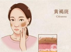 激光祛斑怎么樣？有哪些缺點(diǎn)