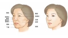 自體脂肪填充額頭有哪些優(yōu)勢？