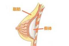 硅膠隆胸的安全性怎么樣？痛嗎