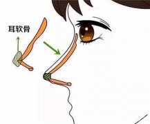 隆鼻失敗后的修復(fù)方法有哪些