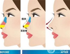 隆鼻術(shù)后吃什么可以快速恢復(fù)