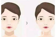 腹部吸脂術(shù)的誤區(qū)有哪些？