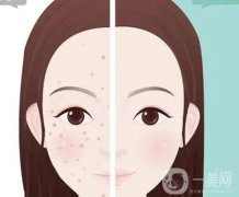 光子嫩膚的效果如何，有哪些副作用