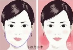 顴骨提升術(shù)有風(fēng)險(xiǎn)嗎？會(huì)不會(huì)失敗