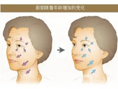 線雕術(shù)后什么時(shí)候可以洗臉
