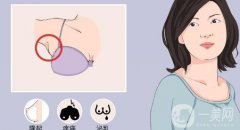 副乳切除術(shù)有哪些風(fēng)險？會影響淋巴嗎