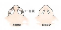 鼻骨矯正手術(shù)如何加快康復(fù)速度？