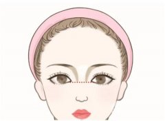 鼻翼切除術(shù)后的恢復(fù)過(guò)程是怎么樣的？
