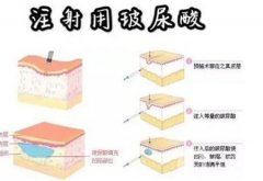 玻尿酸注射臥蠶消腫需要多長時間？