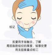 面部吸脂術后需要戴頭套嗎？
