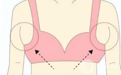 切除副乳安全嗎？有危害嗎