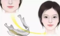 顴骨提升效果能維持多久？