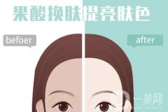 什么是果酸換膚，有什么功效