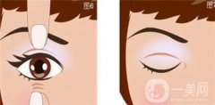 雙眼皮手術(shù)后肉條多久會消失？