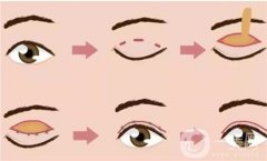 雙眼皮手術(shù)后為什么會有疤痕