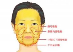水動力吸脂術(shù)的效果能持續(xù)多久