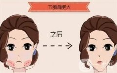 削骨怎么樣？有什么后遺癥