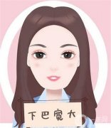自體軟骨墊下巴的特點及適合人群