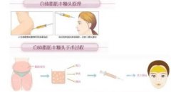 自體脂肪的與什么有關(guān)
