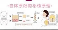 自體脂肪填充后有哪些后遺癥？